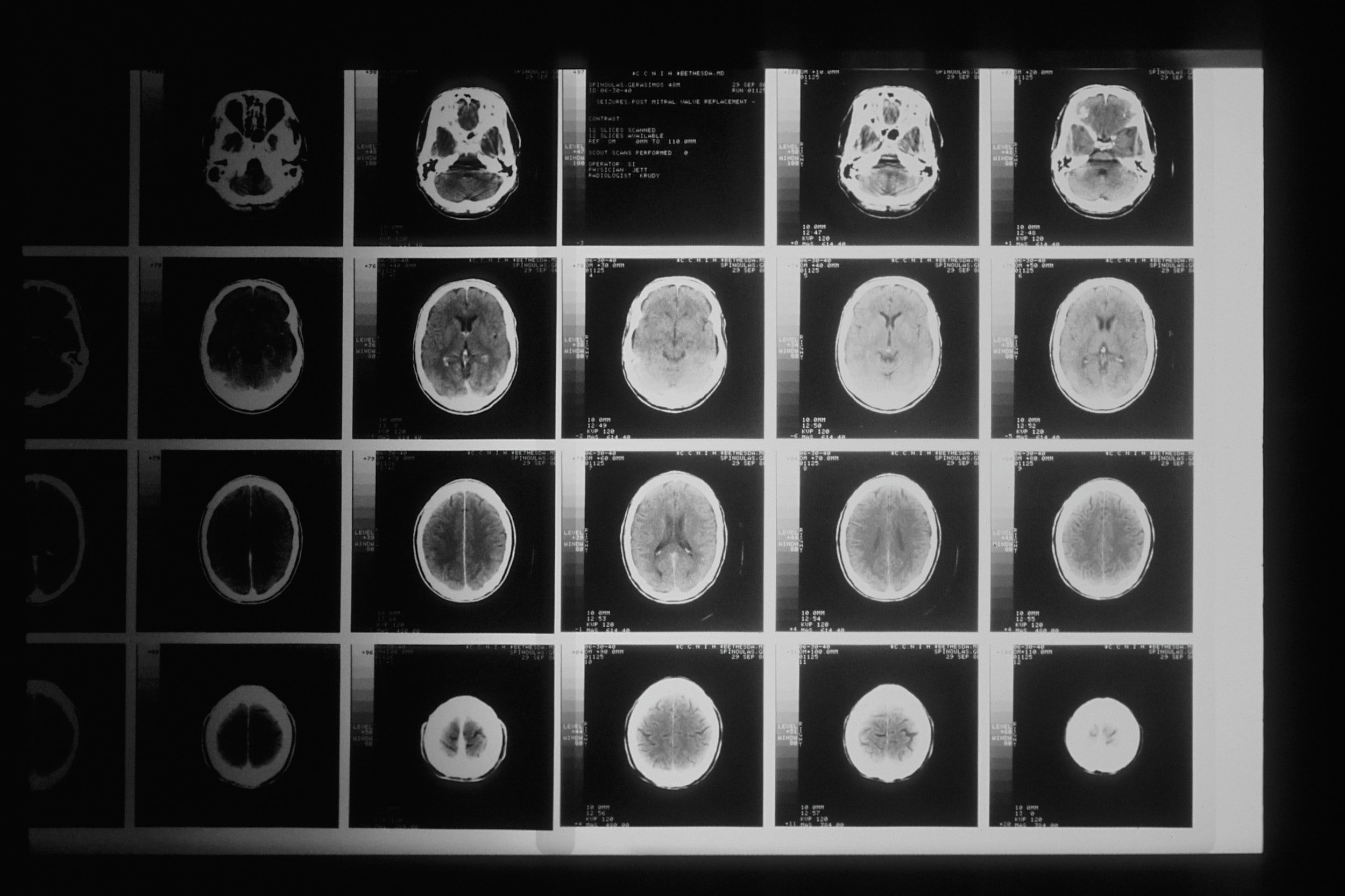 Slices of an MRI scan of the brain